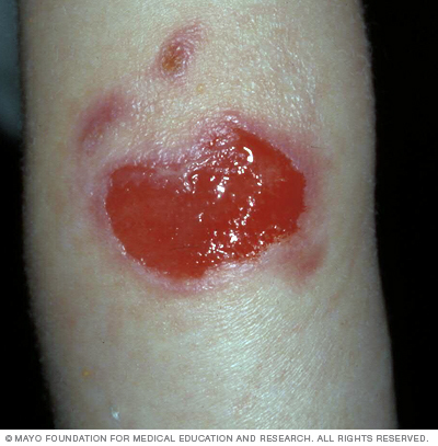 Junctional epidermolysis bullosa can be severe, causing open sores.