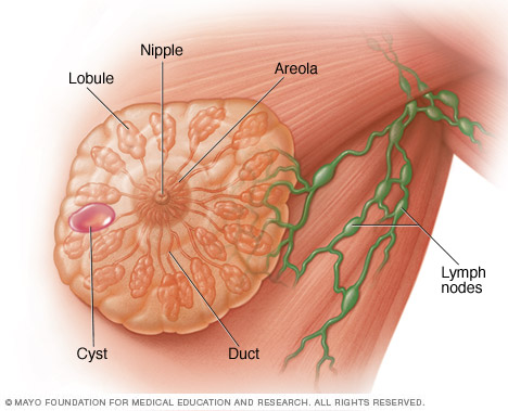 Illustration showing a breast cyst