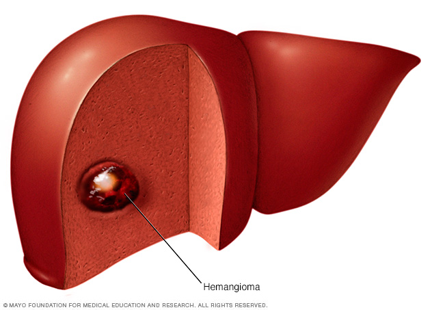 Liver hemangioma