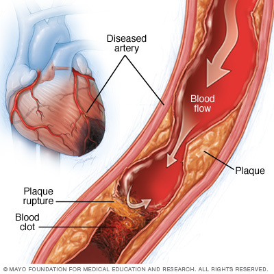 Illustration showing causes of myocardial ischemia 