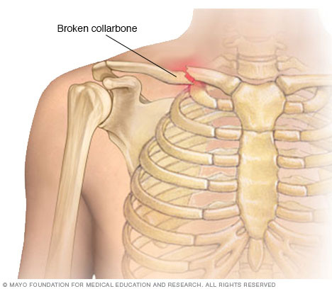 A broken collarbone