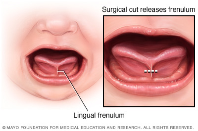 Tongue-tie and release of lingual frenulum