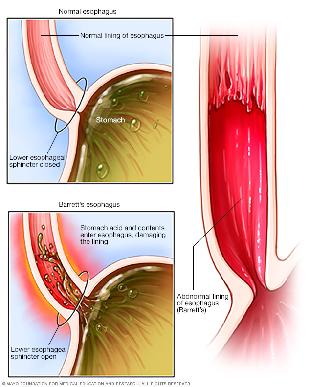 Illustration showing Barrett's esophagus