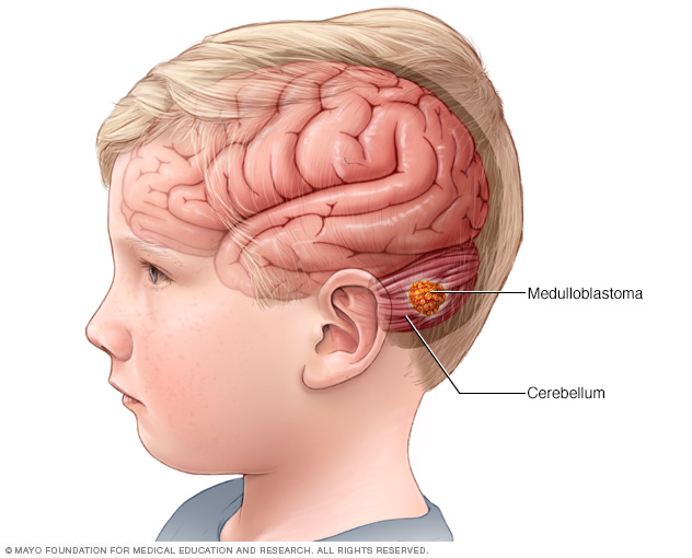 Child with a medulloblastoma brain tumor