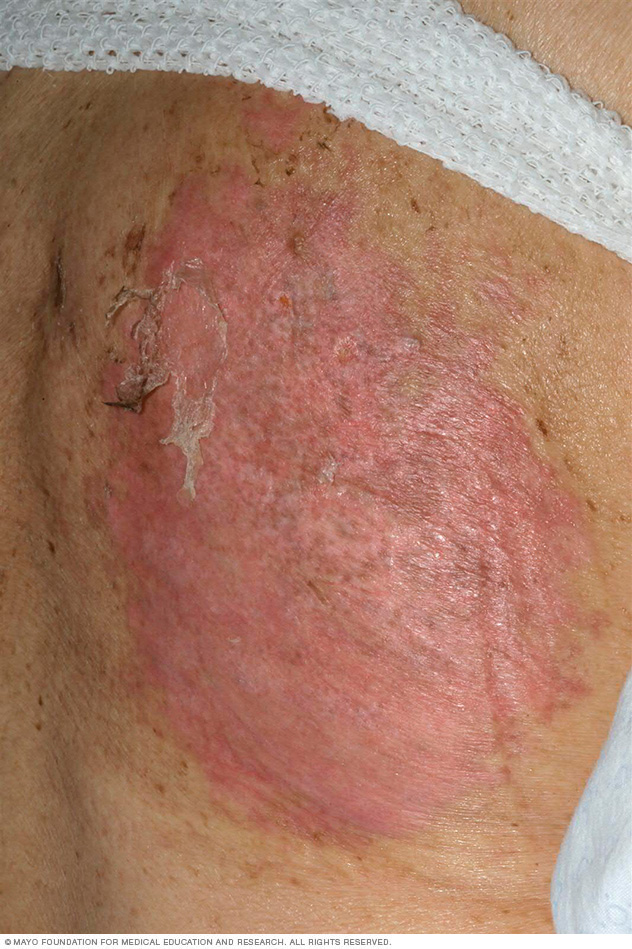 A TEN rash on a woman's back causes loose, peeling skin.