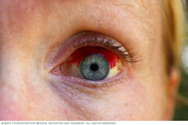Image showing a broken blood vessel in the eye