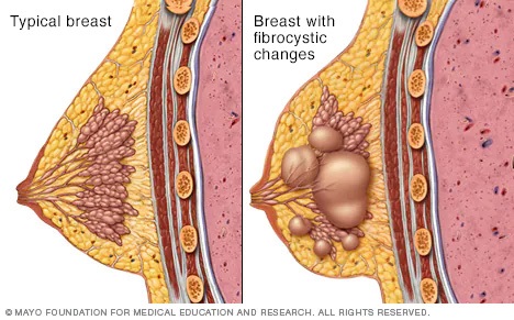 Illustration showing typical breast tissue and a breast with fibrocystic changes