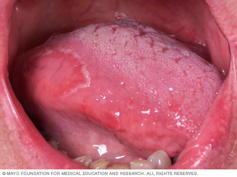 Picture of geographic tongue