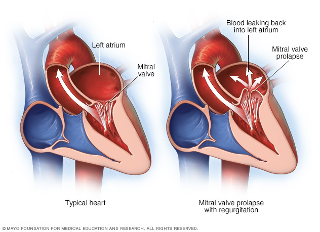 Heart showing mitral valve prolapse and regurgitation