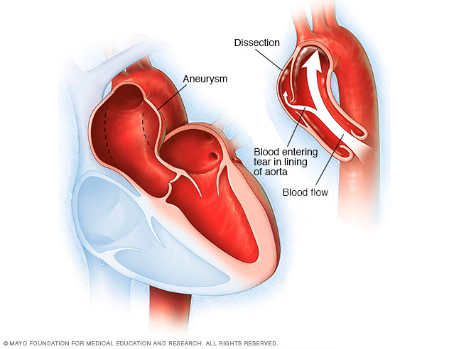 Aortic aneurysm and aortic dissection