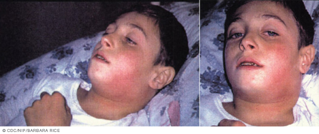 Swollen glands of child with diphtheria 
