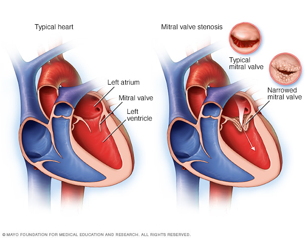 Typical heart and heart with mitral valve stenosis