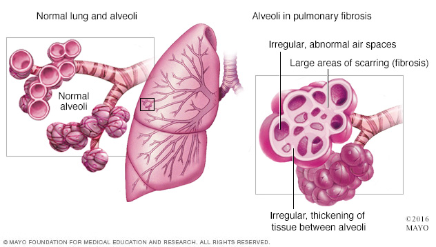 Illustration of pulmonary fibrosis