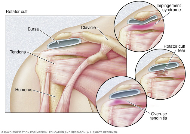 Three types of rotator cuff injuries.
