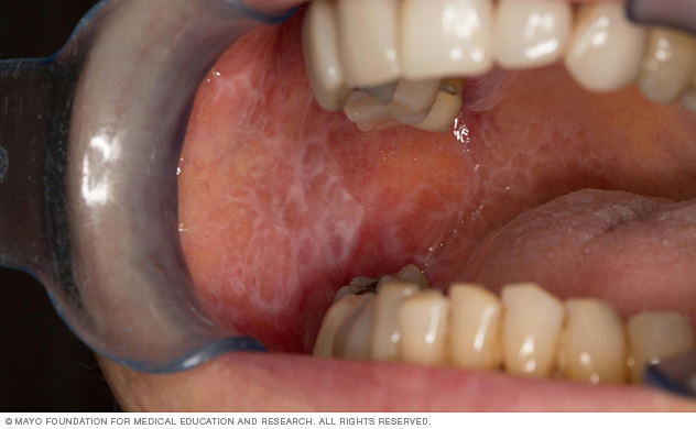 Oral lichen planus lesions cause lacy white patches in the mouth.