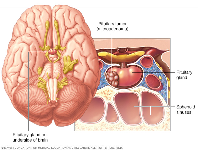 Pituitary tumor