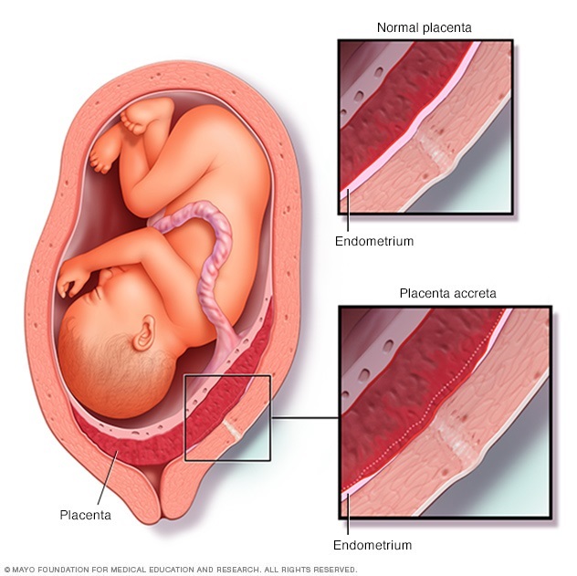 Normal placenta vs. placenta accreta