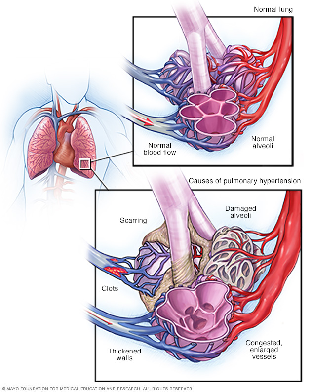 Blood flow in the lungs and pulmonary arteries