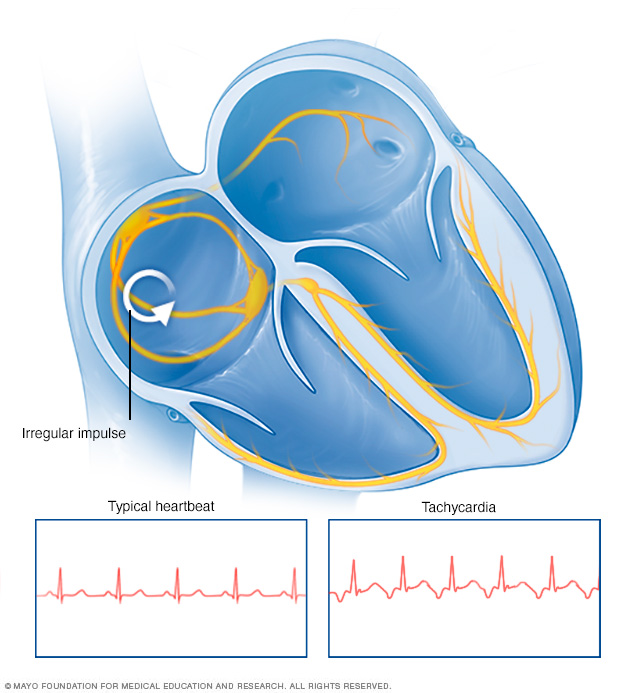 Tachycardia heartbeat
