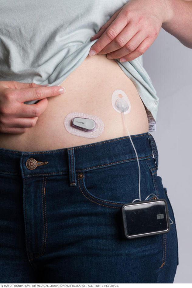 Continuous glucose monitor and insulin pump