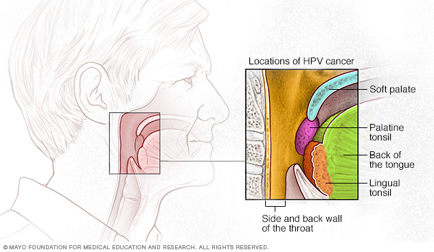 HPV increases the risk of cancer of the throat, soft palate, tonsils and back of the tongue.
