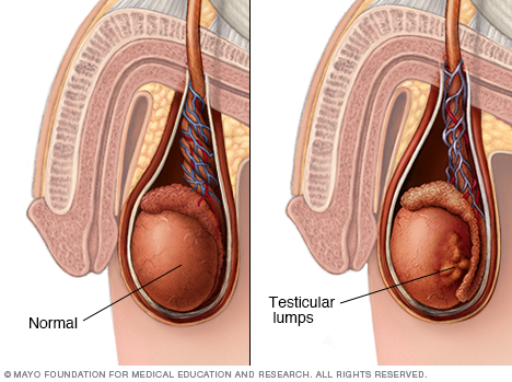 Testicular lumps