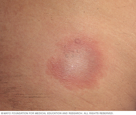 Lyme disease rash on different skin colors.
