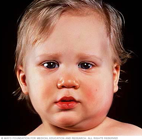 Photograph showing child with mumps