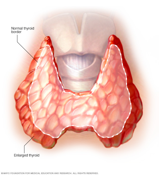Enlarged thyroid