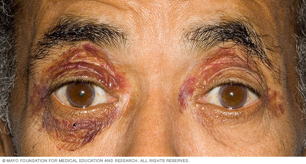 Purpura around the eyes, a sign of amyloidosis