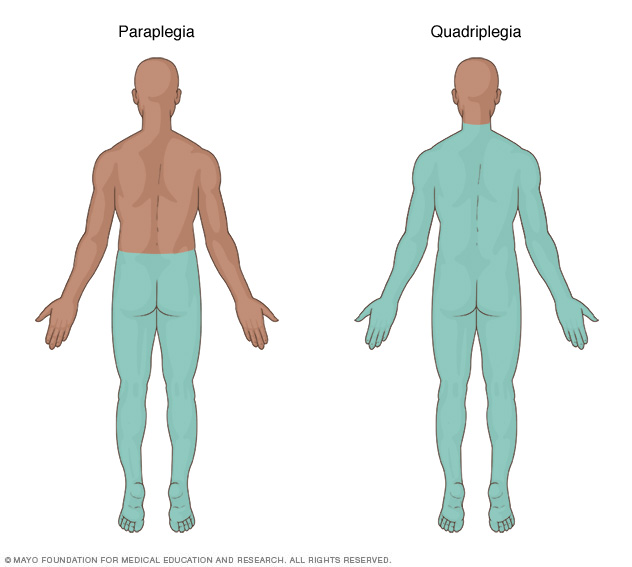 The area of the body affected by paraplegia and quadriplegia