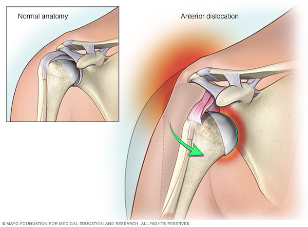 A dislocated shoulder
