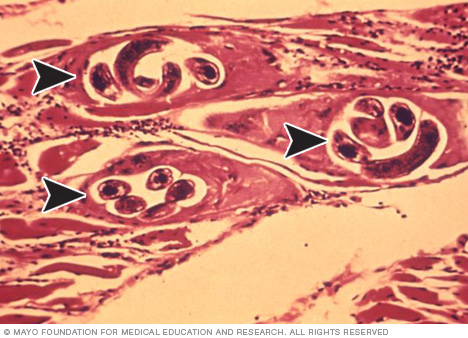 Microscopic view of trichinella cysts in muscle tissue