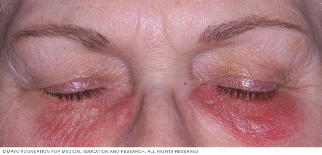 Contact dermatitis under the eyes might be caused by cosmetics