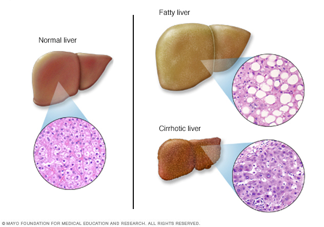 Liver problems showing normal and diseased livers 