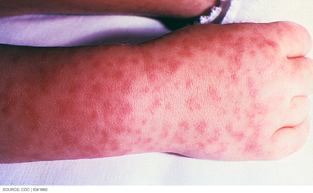 Photograph of rash caused by Rocky Mountain spotted fever
