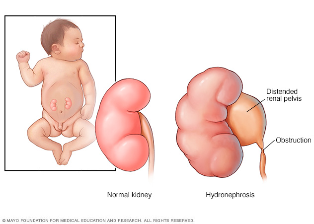 A normal kidney and a kidney with Hydronephrosis in an infant