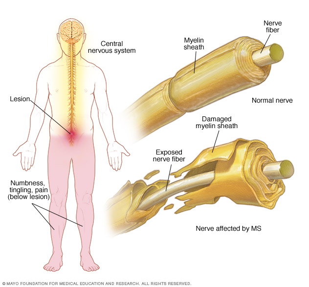 MS-related nervous system damage