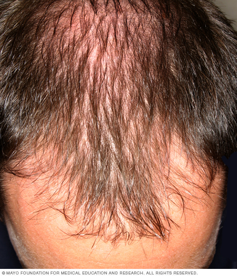 In men, hair often begins to recede from the forehead.