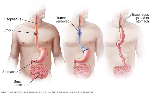 Esophageal cancer surgery