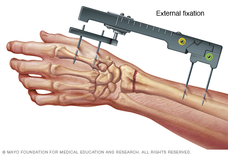 External fixation of a broken wrist