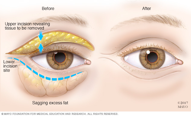 How blepharoplasty is done 