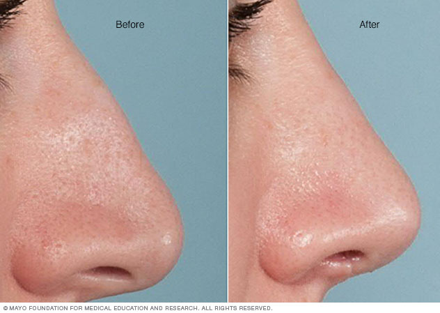 Before-and-after results of rhinoplasty 