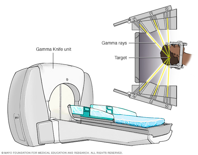 Stereotactic radiosurgery, which uses small gamma rays to deliver a precise dose of radiation to the target