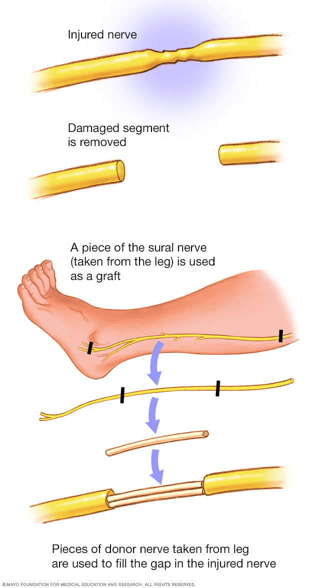A nerve graft from the lower leg