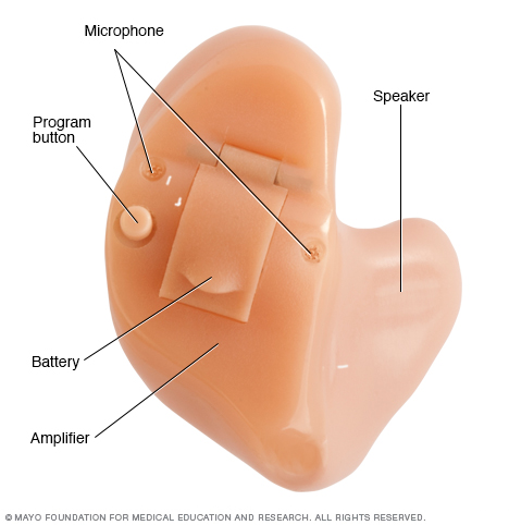 Hearing aid with common parts labeled 