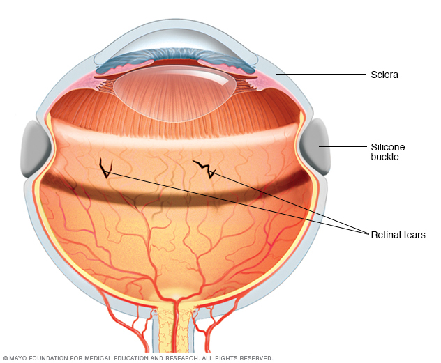 A scleral buckle used to treat retinal detachment