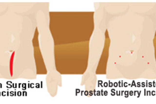 Graphic of two male bodies showing surgical incision versus robotic incisions