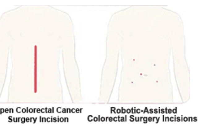Graphic of two backs showing surgical incision versus robotic incisions
